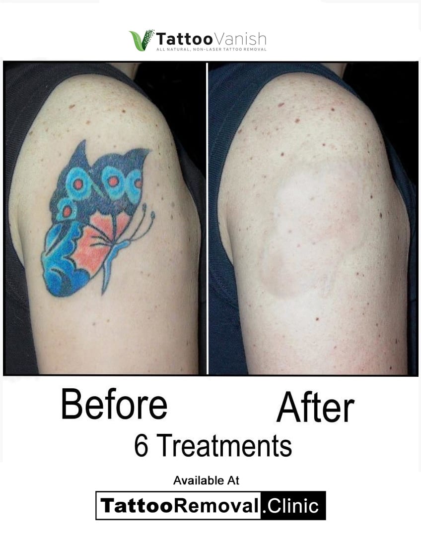 Before and After Tattoo Removal - Get the Best Res (4)
