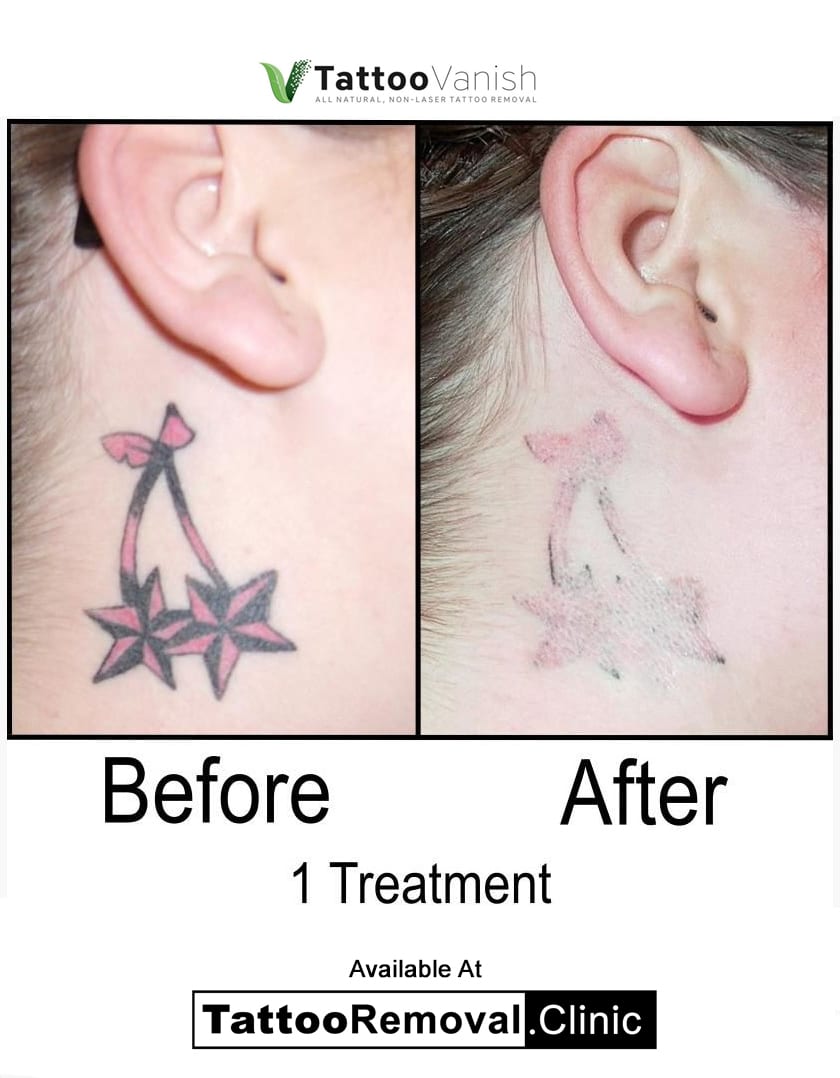 Before and After Tattoo Removal  Get the Best Results the AllNatural Way   Tattoo Vanish  Tattoo removal Laser tattoo removal Laser tattoo