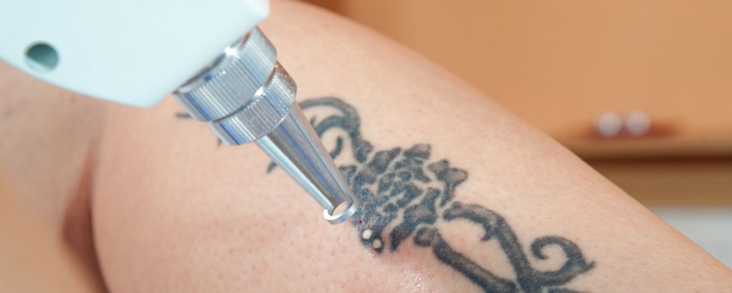 Pros and Cons of Laser Tattoo Removal