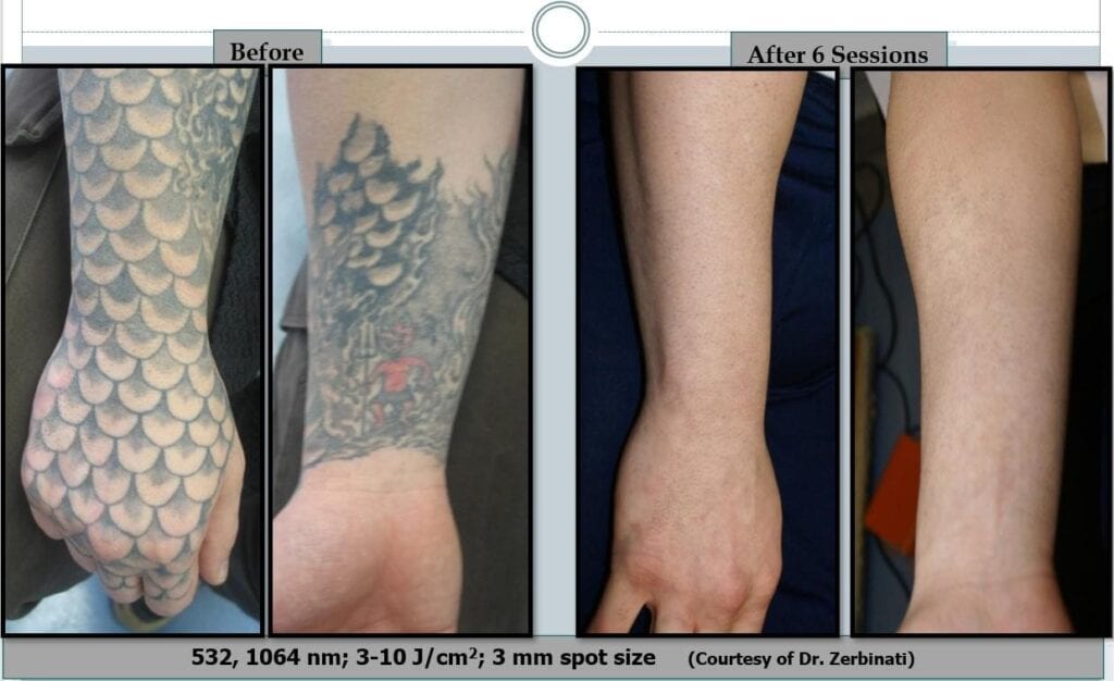 Nd Yag Laser Tattoo Removal For Professional at Rs 65000 in Delhi  ID  23975080833