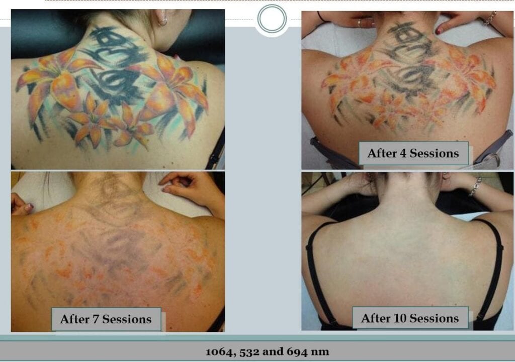 PicoSure Laser Tattoo Removal