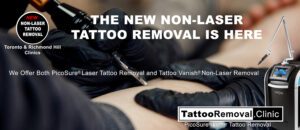 picosure laser tattoo removal