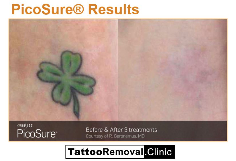 Pico Tattoo Removal Before and After6