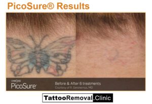Pico Tattoo Removal Before and After7