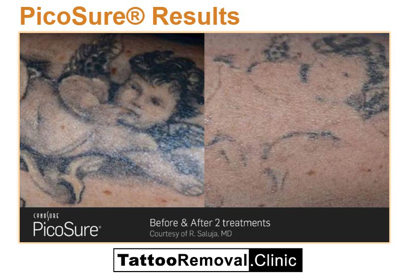 Pico Tattoo Removal Before and After8