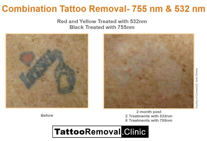 Pico tattoo removal before and after 2