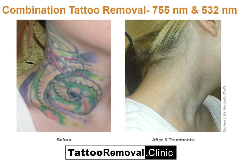 Pico tattoo removal before and after 3
