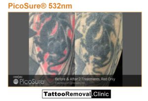 Pico tattoo removal before and after 4