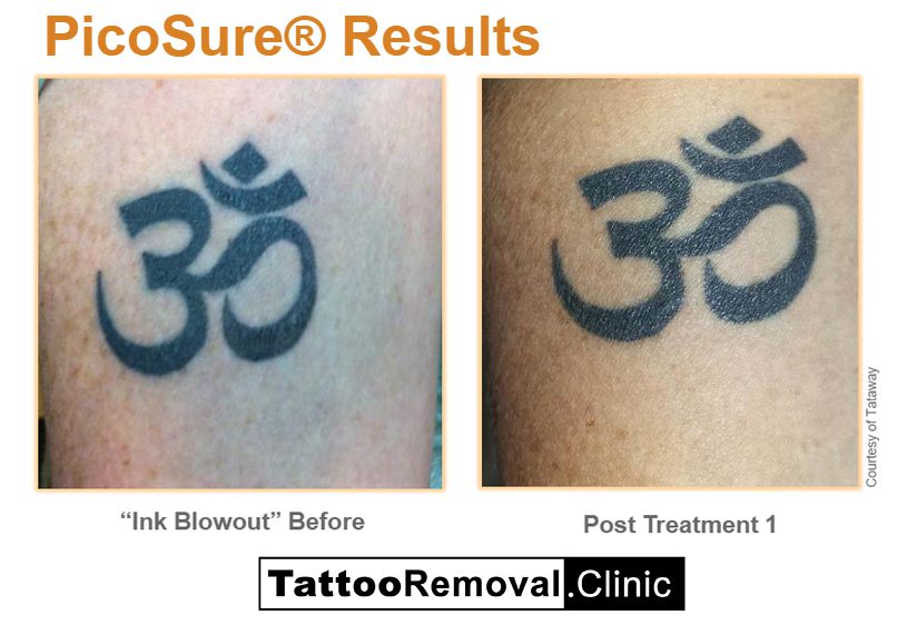 Pico tattoo removal before and after 5