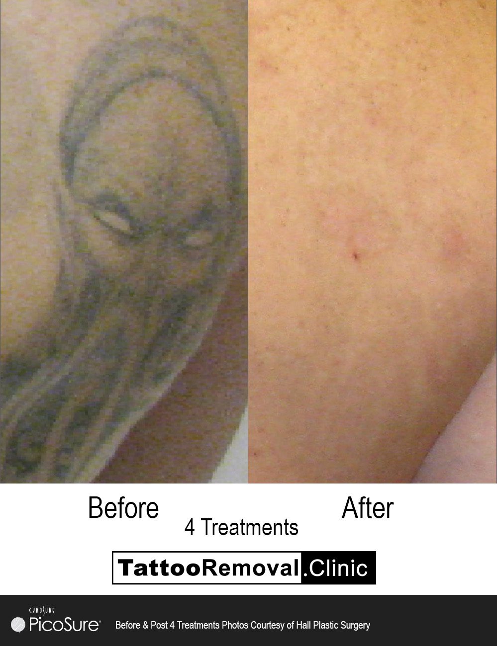 Pico Tattoo Removal Before and After