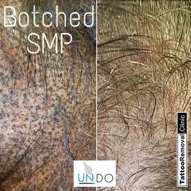 SMP hair scalp tattoo
