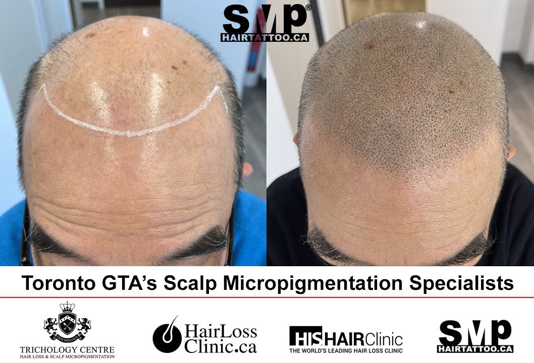 SMP Tattoo Removal | SMP Hair | Scalp Tattoo | SMP Toronto