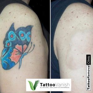 Tattoo Vanish Tattoo Remover