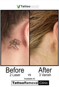 before and after laser tattoo removal