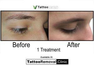 before and after tattoo removal Toronto