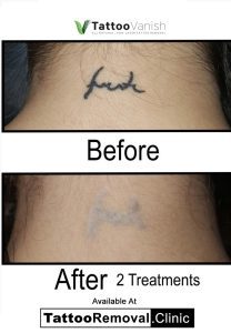 color tattoo removal before and after