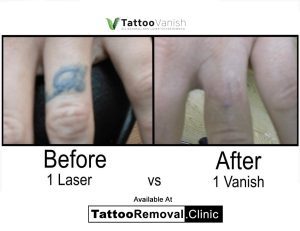 dark skin tattoo removal before and after