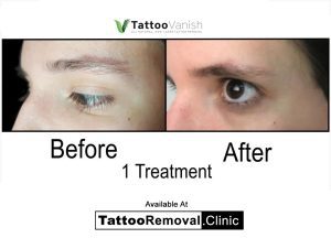 dark tattoo removal before and after