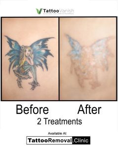 does laser tattoo removal hurt
