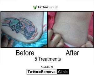 face tattoo removal before and after
