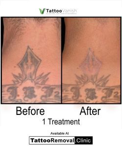 laser removal tattoo toronto