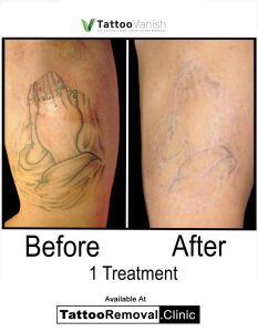 laser tattoo removal before and after Toronto