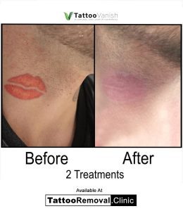 laser tattoo removal before and after - tattoo removal cost