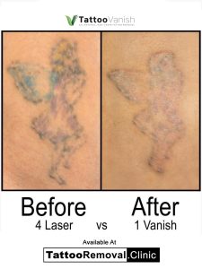laser tattoo removal cost Toronto