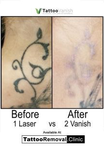 lemon juice tattoo removal before and after