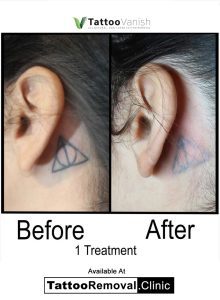 pico tattoo laser tattoo removal