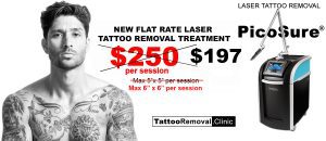 picosure laser tattoo removal Toronto