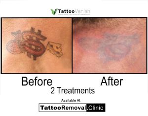 picosure - laser tattoo removal - tattoo removal cost