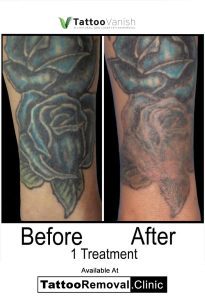 picosure tattoo removal before and after