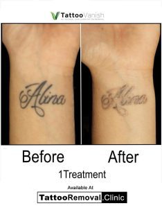picosure tattoo removal - laser tattoo removal cost