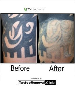 removing face tattoos - tattoo removal cost