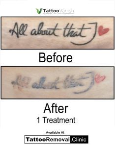 tattoo laser removal