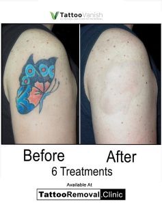 tattoo removal before and after face