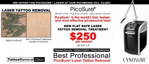 tattoo removal cost laser tattoo removal Toronto 1