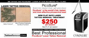 tattoo removal cost laser tattoo removal Toronto