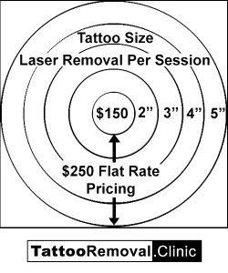 tattoo removal cost - tattoo removal Toronto