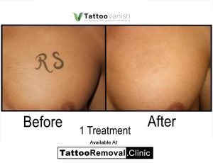 tattoo removal - laser tattoo removal cost