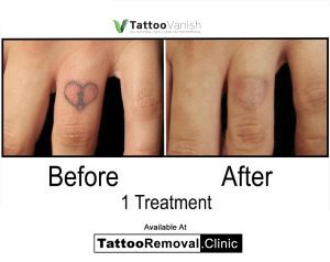 tattoo removal service - tattoo removal cost
