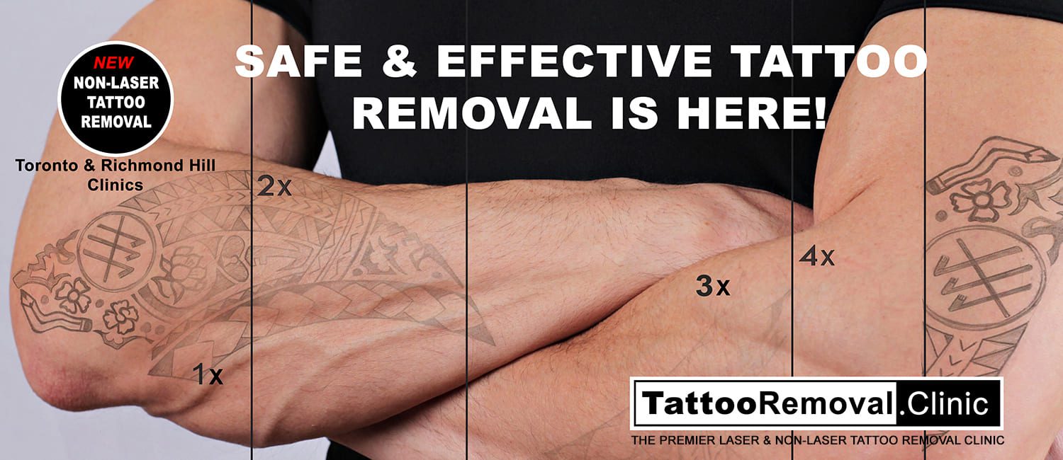 9 Things You Need to Know Before Getting Laser Tattoo Removal